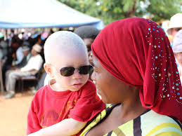 albinism zw